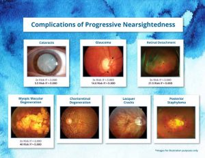 Myopia Control | Advanced Eyecare of Chino Optometry | Chino, CA | Eye Exam